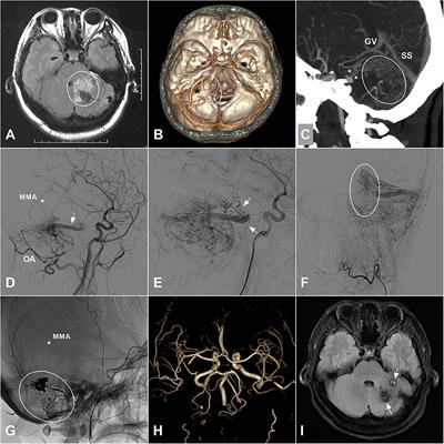 Intracranial Dural Arteriovenous Fistulas With Brainstem Engorgement: An Under-Recognized Entity in Diagnosis and Treatment